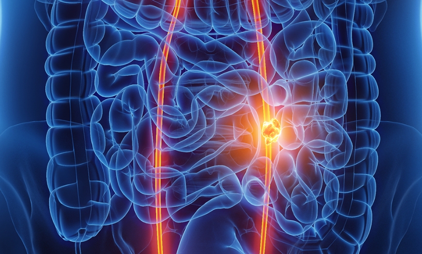 요로결석 이미지, 신장결석과 요관결석으로 인한 통증 및 혈뇨 원인 설명