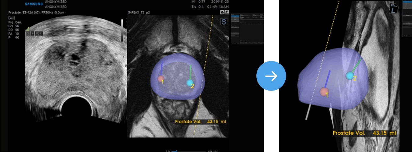전립선 MRI 초음파 융합 3D 모델링, 병변 위치를 입체적으로 시각화해 정확한 조직검사 경로를 설정하는 시스템