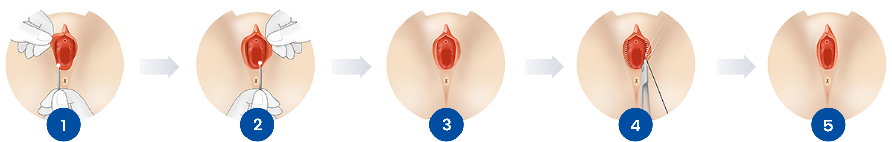 소음순 성형 수술 과정 단계별 이미지, 소음순 비대칭 교정과 늘어진 소음순 개선을 위한 절개 디자인 봉합 회복 과정을 설명하는 여성성형 수술 순서도