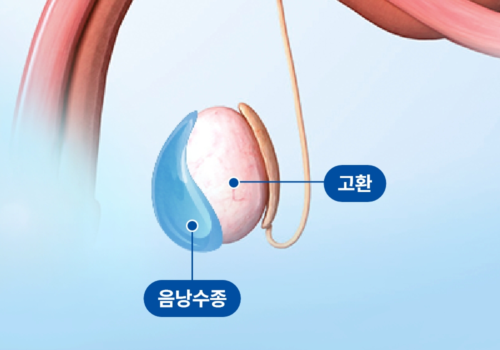 음낭수종 의료 이미지, 고환 주변에 액체가 차서 음낭이 붓는 음낭수종의 구조와 치료가 필요한 질환 설명