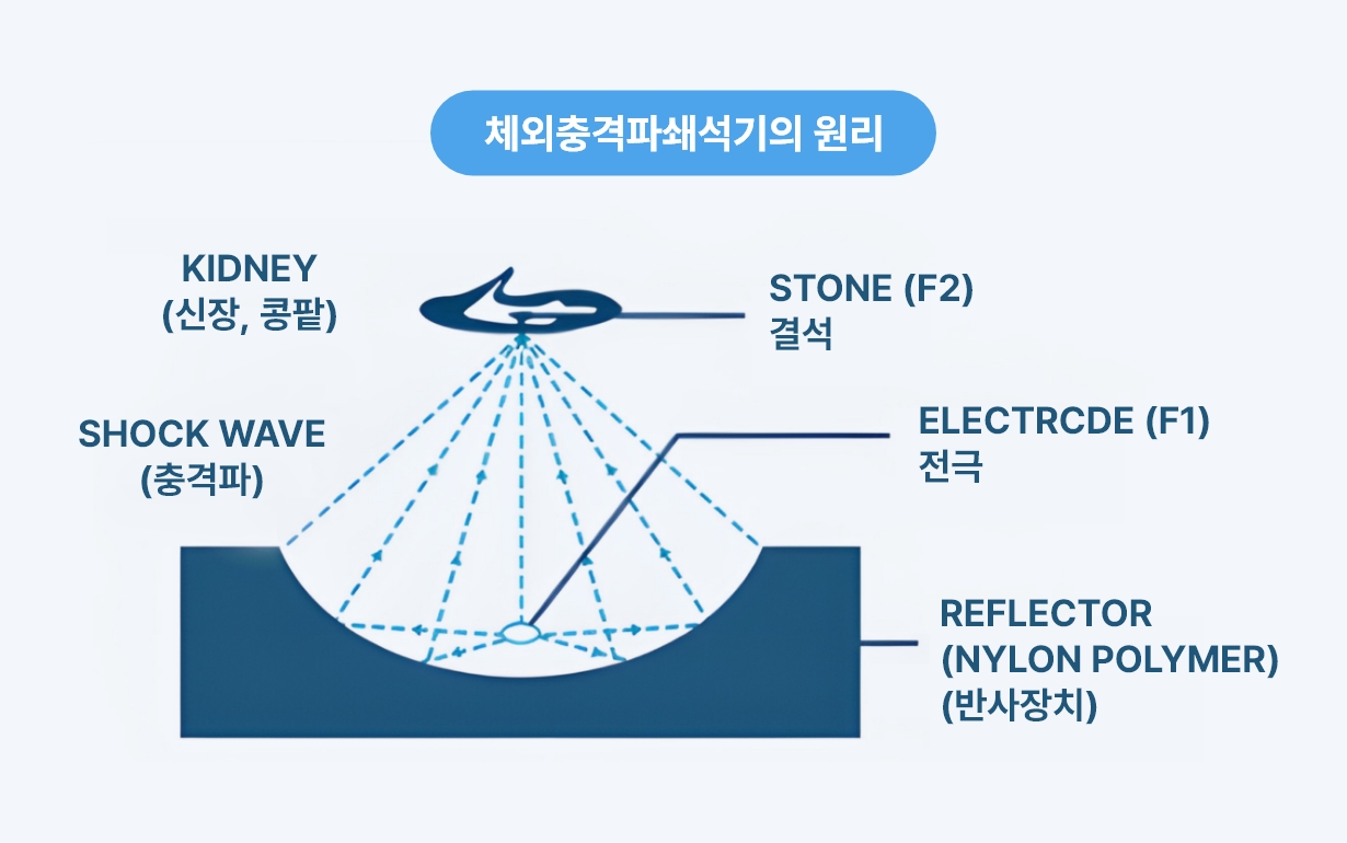 체외충격파쇄석술 작동 원리 이미지, 충격파가 반사장치를 통해 결석에 집중되어 분쇄되는 과정