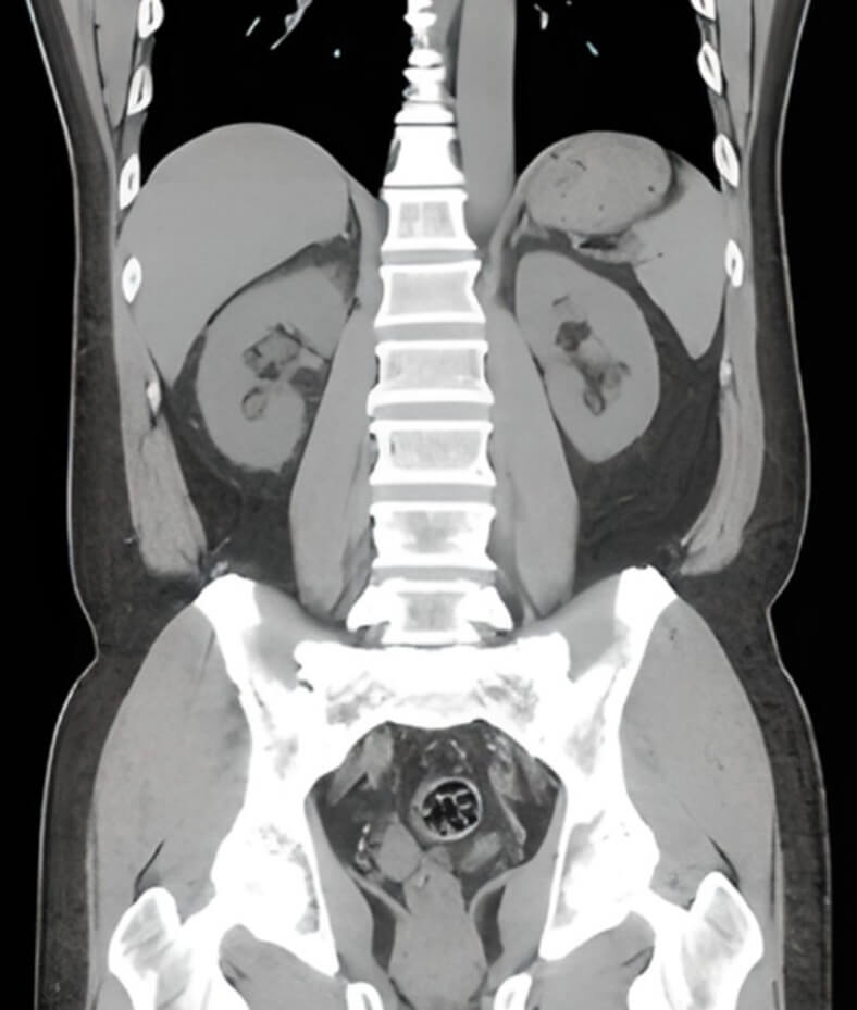 복부 CT 관상면 이미지, 신장 구조와 요로 상태를 확인하는 비뇨기계 정밀 CT 검사
