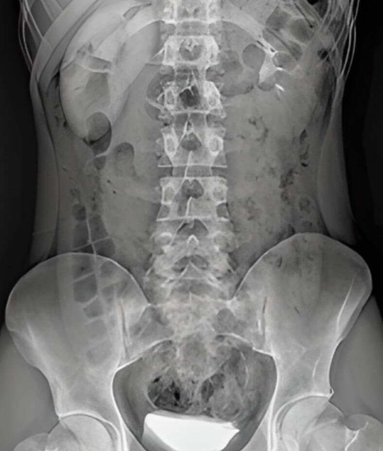복부 X-ray 이미지, 요로결석 위치와 크기 확인을 위한 비뇨기 단순 방사선 검사